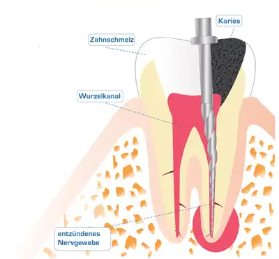 Prophylaxe